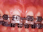 fase intermediaria movimentacao-ortodontica