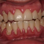 Paciente do sexo masculino, 20 anos de idade, apresentando gengivite, periodontite e retração gengival e periodontal generalizada.