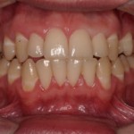 periodontia-apos-tratamento-150x150