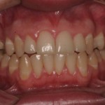 Paciente submetido ao tratamento periodontal básico: Motivação à higiene bucal, raspagem e polimento.