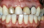 Paciente: 41 anos de idade, portadora de periodontite crônica e dentição antiestética.