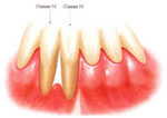 retracao-gengival-classe-4-a