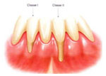 retracao-gengival-classes-1-2