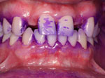 10-implantes-dentarios