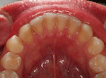 11-implantes-dentarios