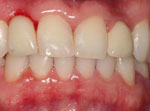 12-implantes-dentarios