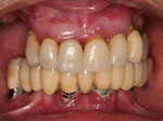 13-implantes-dentarios