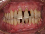 14-implantes-dentarios