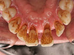 15-implantes-dentarios