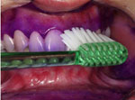 16-implantes-dentarios