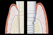 18-implantes-dentarios