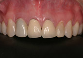 3-implantes-dentarios