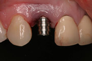 4-implantes-dentarios