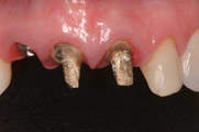 5-implantes-dentarios