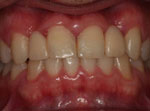 8-implantes-dentarios
