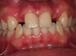9-implantes-dentarios