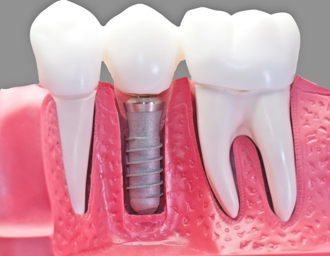 implantes-dentarios.jpg