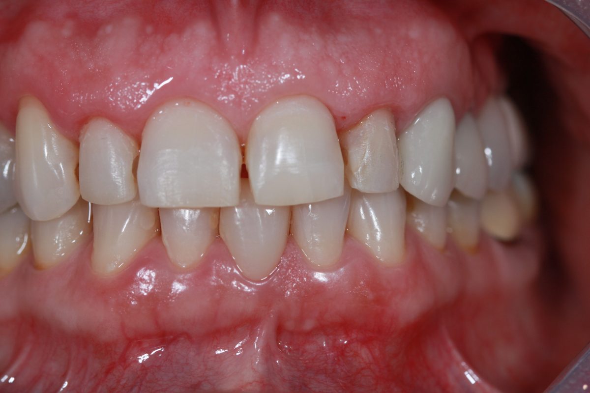 Lentes de contato dental - Caso Clínico