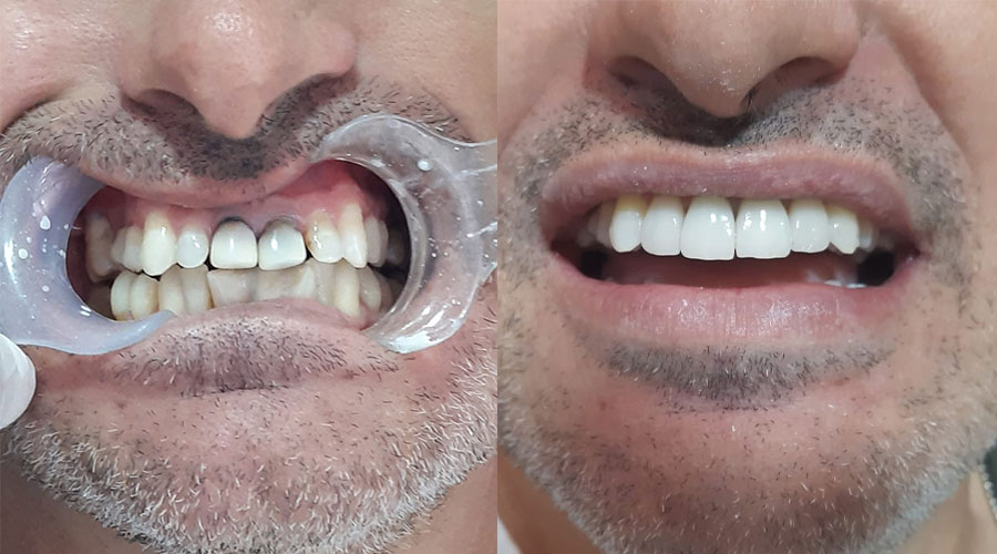 lente-de-contato-dental-2022-couto-antes-depois.jpg