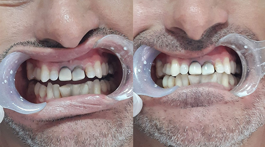 Lente de contato dental: Antes