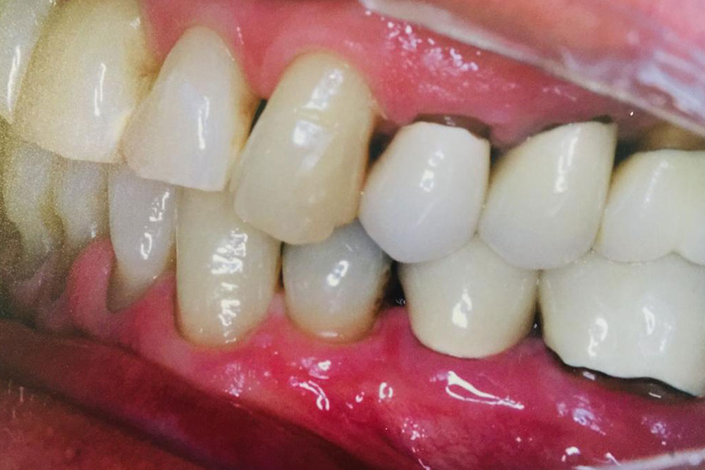 tratamento-periodontal