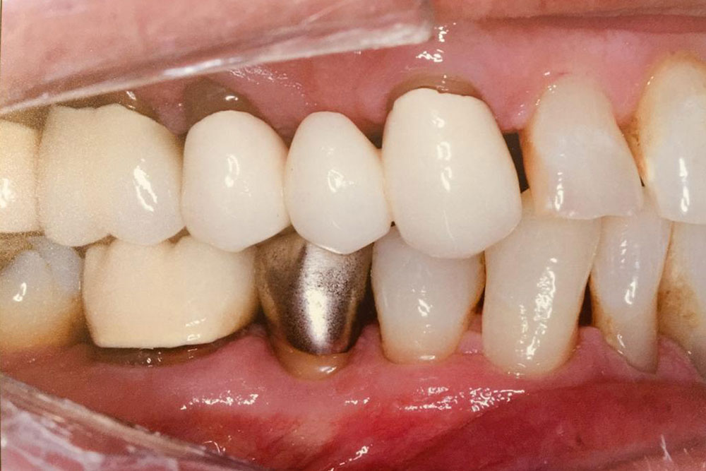 tratamento-periodontal-2