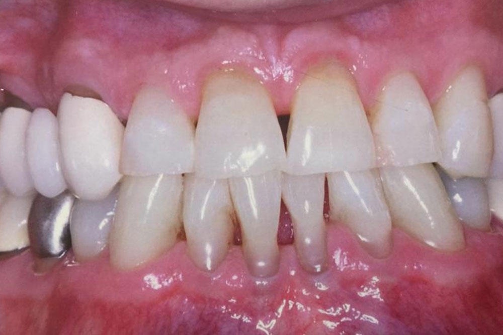 tratamento-periodontal-3.jpg