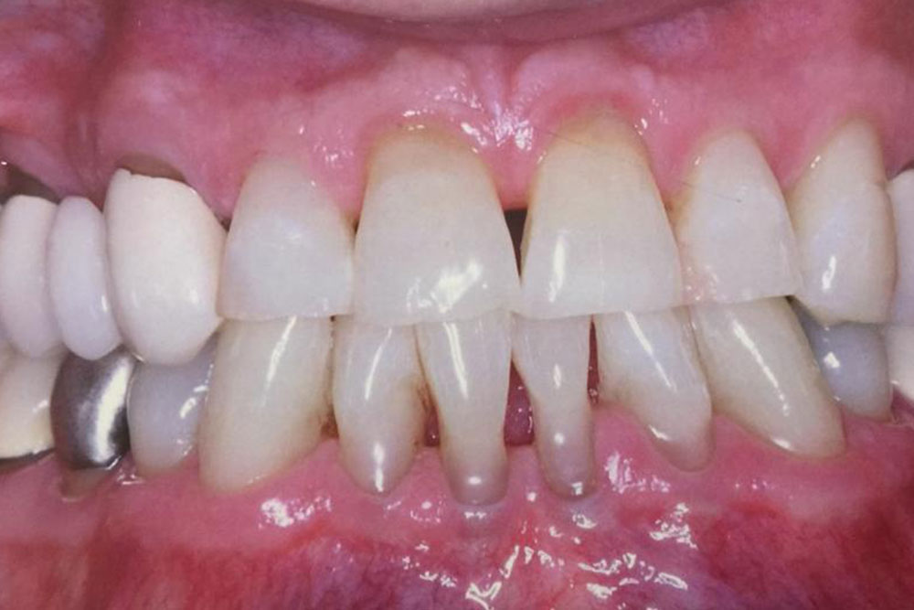 tratamento-periodontal-3